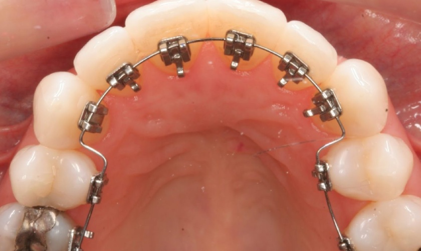 Niềng răng mặt trong có tính thẩm mỹ cao